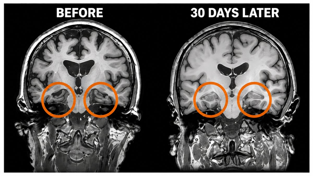 Brain Scan Before vs 30 Days Later
